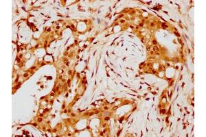 IHC image of nohHU diluted at 1:8 and staining in paraffin-embedded human breast cancer performed on a Leica BondTM system. (HIST1H4A 抗体  (AA 85-96))