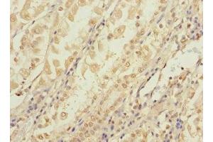 Immunohistochemistry of paraffin-embedded human gastric cancer using ABIN7148092 at dilution of 1:100 (CCDC15 抗体  (AA 1-245))