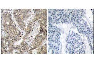 Immunohistochemical analysis of paraffin-embedded human breast carcinoma tissue, using β-Catenin (Ab-37) antibody (E021212). (beta Catenin 抗体)