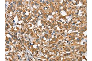 The image on the left is immunohistochemistry of paraffin-embedded Human thyroid cancer tissue using ABIN7190368(CSMD1 Antibody) at dilution 1/40, on the right is treated with synthetic peptide. (CSMD1 抗体)