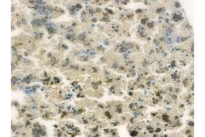 ABIN6260356 and ABIN6278190 at 1/100 staining human melanoma by IHC-P. (BORA 抗体  (C-Term))