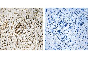 Peptide - +Immunohistochemistry analysis of paraffin-embedded human breast carcinoma tissue, using CIB2 antibody. (CIB2 抗体  (Internal Region))