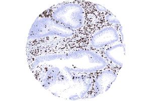 Colon Strong CD7 staining of a large fraction of tumor infiltrating lymphocytes in a colorectal adenocarcinoma. (Recombinant CD7 抗体)
