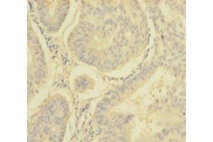 Immunohistochemistry of paraffin-embedded human endometrial cancer using ABIN7160909 at dilution of 1:100