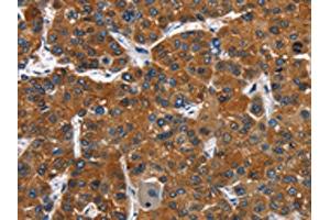 The image on the left is immunohistochemistry of paraffin-embedded Human liver cancer tissue using ABIN7128793(CATSPER3 Antibody) at dilution 1/60, on the right is treated with fusion protein. (CATSPER3 抗体)