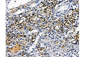 ABIN7094959 and ABIN7099015 at 1/100 staining human esophageal cancer by IHC-P.