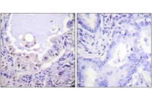 Immunohistochemistry analysis of paraffin-embedded human lung carcinoma tissue, using C-RAF (Ab-621) Antibody. (RAF1 抗体  (AA 591-640))