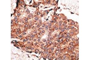 IHC analysis of FFPE human breast carcinoma tissue stained with the BMP1 antibody (BMP1 抗体  (AA 957-986))