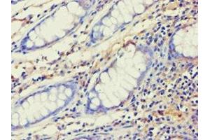 Immunohistochemistry of paraffin-embedded human colon cancer using ABIN7143993 at dilution of 1:100 (AES 抗体  (N-Term))