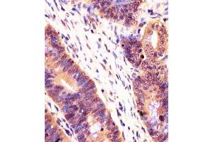 (ABIN6243729 and ABIN6578258) staining PSMB7 in human colorectal carcinoma tissue sections by Immunohistochemistry (IHC-P - paraformaldehyde-fixed, paraffin-embedded sections).