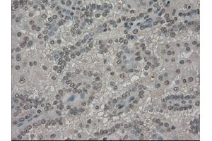 Immunohistochemical staining of paraffin-embedded Carcinoma of kidney tissue using anti-SLC7A8mouse monoclonal antibody. (SLC7A8 抗体)