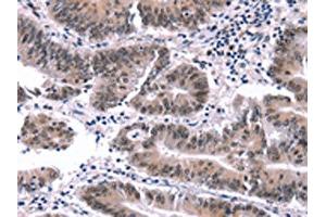 The image on the left is immunohistochemistry of paraffin-embedded Human colon cancer tissue using ABIN7191561(MYF5 Antibody) at dilution 1/15, on the right is treated with synthetic peptide. (MYF5 抗体)