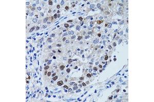 Immunohistochemistry of paraffin-embedded human lung cancer using UHRF1 antibody. (UHRF1 抗体  (AA 1-260))