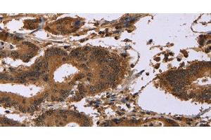 Immunohistochemistry of paraffin-embedded Human colon cancer using EDN2 Polyclonal Antibody at dilution of 1:30 (Endothelin 2 抗体)