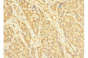 Immunohistochemistry of paraffin-embedded human ovarian cancer using ABIN7171721 at dilution of 1:100 (CCDC79 抗体  (AA 301-550))