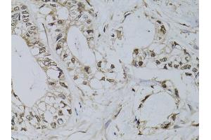 Immunohistochemistry of paraffin-embedded human gastric cancer using PML antibody (ABIN5970530) at dilution of 1/100 (40x lens). (PML 抗体)
