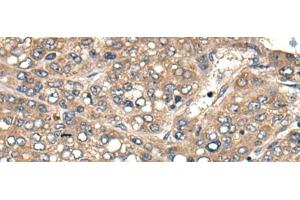 Immunohistochemistry of paraffin-embedded Human liver cancer tissue using ACER1 Polyclonal Antibody at dilution of 1:50(x200) (ACER1 抗体)