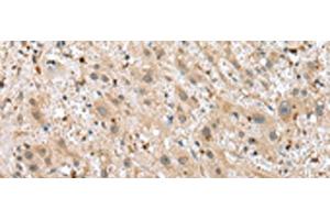 Immunohistochemistry of paraffin-embedded Human liver cancer tissue using TPPP Polyclonal Antibody at dilution of 1:25(x200) (Tppp 抗体)