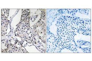 Immunohistochemistry analysis of paraffin-embedded human breast carcinoma tissue using PHLDA3 antibody. (PHLDA3 抗体  (Internal Region))