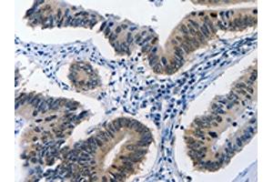 The image on the left is immunohistochemistry of paraffin-embedded Human colon cancer tissue using ABIN7190002(BPIFB1 Antibody) at dilution 1/40, on the right is treated with synthetic peptide. (BPIFB1 抗体)