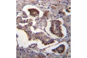 Immunohistochemistry analysis of GUF1 Antibody (N-term) in formalin fixed and paraffin embedded human prostate carcinoma followed by peroxidase conjugation of the secondary antibody and DAB staining. (GUF1 抗体  (N-Term))