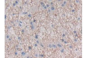 DAB staining on IHC-P; Samples: Human Glioma Tissue (IFNE 抗体  (AA 30-208))
