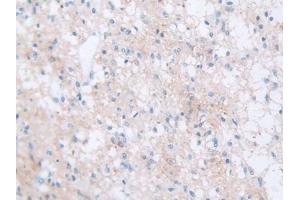 Detection of FBN1 in Human Glioma Tissue using Polyclonal Antibody to Fibrillin 1 (FBN1) (Fibrillin 1 抗体  (AA 723-902))