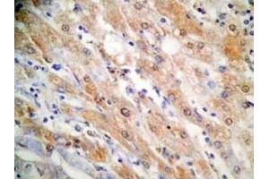 Human hepatocellular carcinoma tissue was stained by Rabbit Anti-FGF-21 (26-47) (H) Antibody (FGF21 抗体  (AA 26-47))