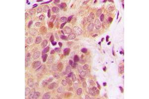 Immunohistochemical analysis of BRCA2 staining in human breast cancer formalin fixed paraffin embedded tissue section. (BRCA2 抗体  (N-Term))