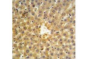 Annexin V antibody IHC analysis in formalin fixed and paraffin embedded human hepatocarcinoma. (Annexin V 抗体  (AA 1-30))