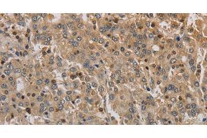 Immunohistochemistry of paraffin-embedded Human liver cancer using ADO Polyclonal Antibody at dilution of 1:30 (ADO 抗体)
