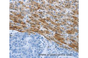 Immunohistochemistry of Human liver cancer using PSMD11 Polyclonal Antibody at dilution of 1:50 (PSMD11 抗体)
