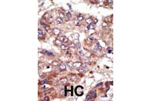 Formalin-fixed and paraffin-embedded human cancer tissue reacted with the primary antibody, which was peroxidase-conjugated to the secondary antibody, followed by AEC staining. (ACSL6 抗体  (AA 240-270))