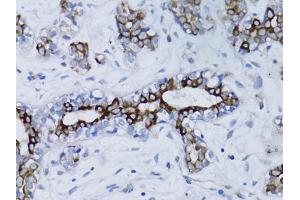 Immunohistochemistry of paraffin-embedded human breast cancer using BRCA1 antibody. (BRCA1 抗体)