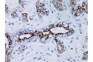 Immunohistochemistry of paraffin-embedded human breast cancer using BRCA1 antibody.