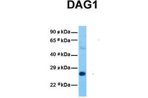 Host:  Rabbit  Target Name:  DAG1  Sample Tissue:  Human Stomach Tumor  Antibody Dilution:  1. (Dystroglycan 抗体  (Middle Region))