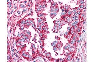 Anti-WNT5B antibody IHC of human Lung, Non-Small Cell Carcinoma.