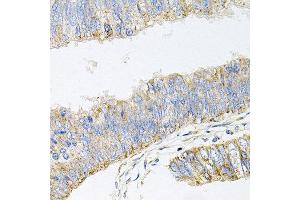 Immunohistochemistry of paraffin-embedded human colon carcinoma using GP2 antibody at dilution of 1:100 (x40 lens).