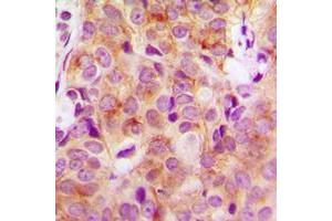 Immunohistochemical analysis of HGS staining in human breast cancer formalin fixed paraffin embedded tissue section. (HGS 抗体  (Center))