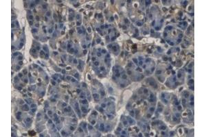 Detection of RNASE3 in Human Pancreatic cancer Tissue using Monoclonal Antibody to Ribonuclease A3 (RNASE3) (RNASE3 抗体  (AA 30-154))