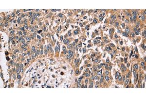 Immunohistochemistry of paraffin-embedded Human lung cancer using FUCA1 Polyclonal Antibody at dilution of 1:30 (FUCA1 抗体)