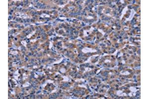 The image on the left is immunohistochemistry of paraffin-embedded Human thyroid cancer tissue using ABIN7191187(KCNJ9 Antibody) at dilution 1/30, on the right is treated with synthetic peptide. (KCNJ9 抗体)