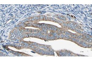 ABIN6278876 at 1/100 staining Human cervical cancer tissue by IHC-P. (IFIT2 抗体  (Internal Region))