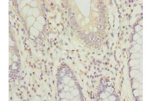 Immunohistochemistry of paraffin-embedded human colon cancer using ABIN7167582 at dilution of 1:100