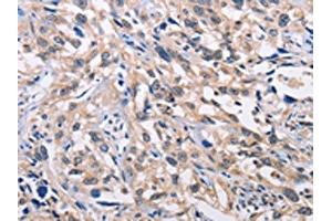 The image on the left is immunohistochemistry of paraffin-embedded Human esophagus cancer tissue using ABIN7128359(ALG8 Antibody) at dilution 1/30, on the right is treated with fusion protein. (ALG8 抗体)