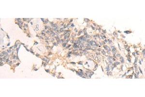 Immunohistochemistry of paraffin-embedded Human ovarian cancer tissue using IBA57 Polyclonal Antibody at dilution of 1:65(x200) (IBA57 抗体)