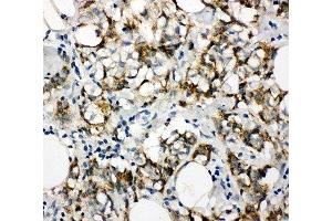 IHC-P: Cytokeratin 8 antibody testing of human breast cancer tissue