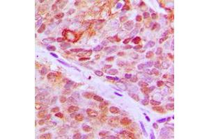 Immunohistochemical analysis of ZNF148 staining in human breast cancer formalin fixed paraffin embedded tissue section. (ZNF148 抗体  (N-Term))