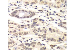 Immunohistochemistry of paraffin-embedded Human colon carcinoma using CCNC Polyclonal Antibody at dilution of 1:100 (40x lens). (Cyclin C 抗体)