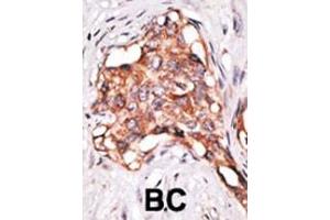 Formalin-fixed and paraffin-embedded human cancer tissue reacted with the primary antibody, which was peroxidase-conjugated to the secondary antibody, followed by DAB staining. (GDF3 抗体  (N-Term))